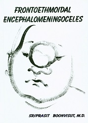 Frontoethmoidal encephalomeningoceles