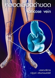 หลอดเลือดดำขอด