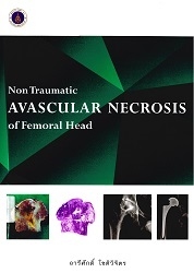 ภาวะหัวกระดูกต้นขาตายจากการขาดเลือด